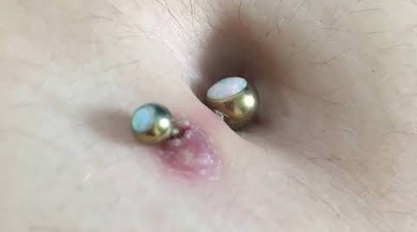 Xỏ rốn bị nhiễm trùng