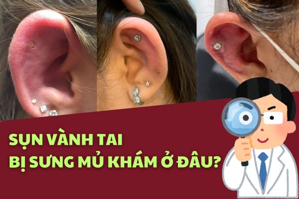 Xỏ sụn vành tai bị sưng mủ khám ở đâu?
