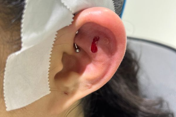 Xỏ sụn vành tai bị sưng mủ khám ở đâu?