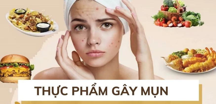 Ăn nhiều thực phẩm gây mụn