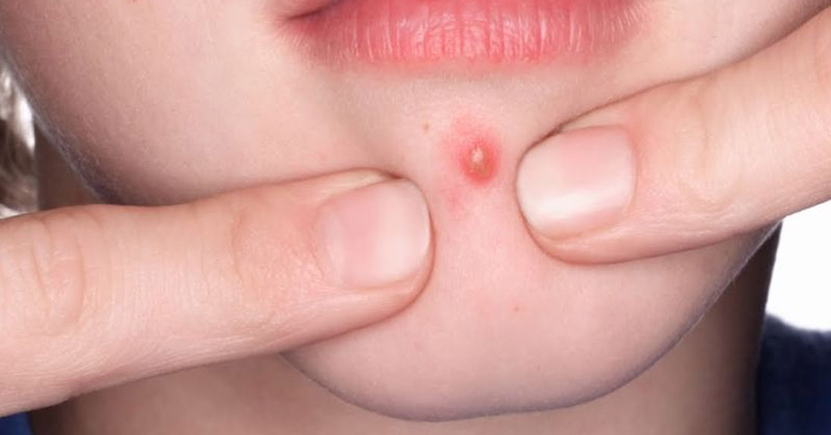 Mụn nhọt có thể xuất hiện ở bất kỳ vùng da nào trên cơ thể.