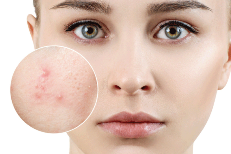 Tại sao cần chăm sóc da mụn ban đêm?