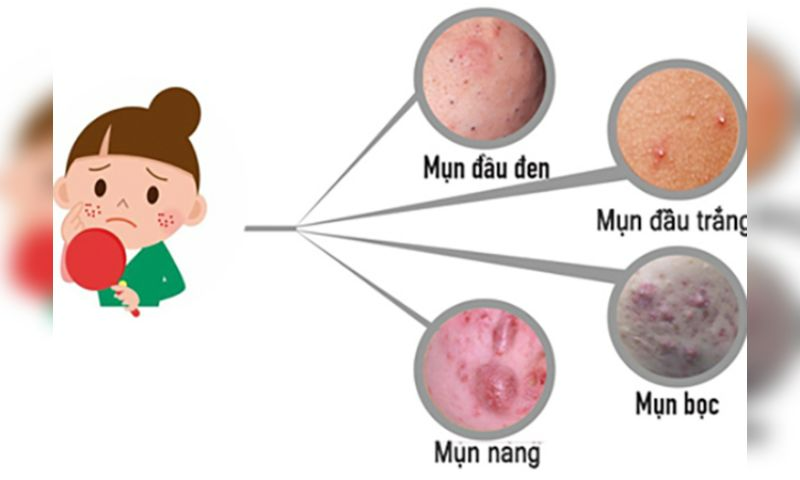 Cách chăm sóc da mụn tuổi dậy thì đúng