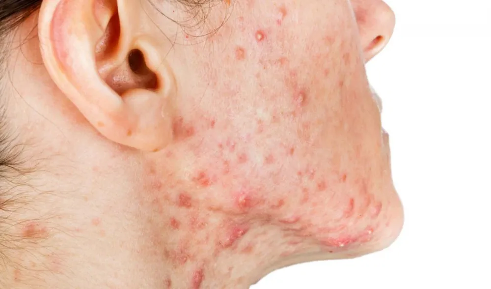 Nguyên nhân bị mụn nội tiết ở nữ