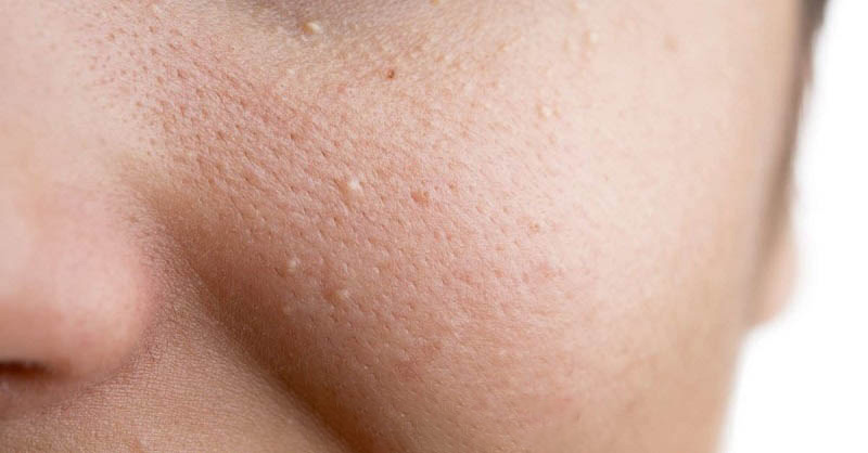 Lý giải cho mọi người biết lớp mụn dưới da