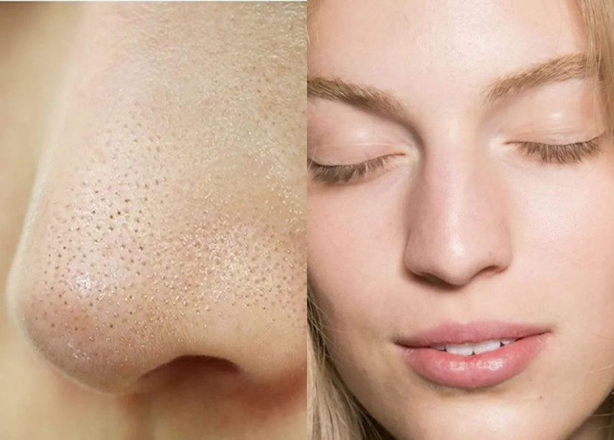 Sự thay đổi nội tiết tố có thể làm tăng mụn cám