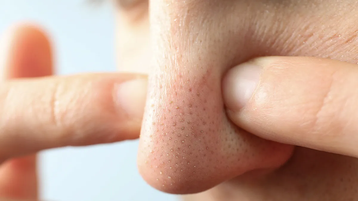 Nặn mụn có thể khiến viêm nhiễm da và tái phát mụn