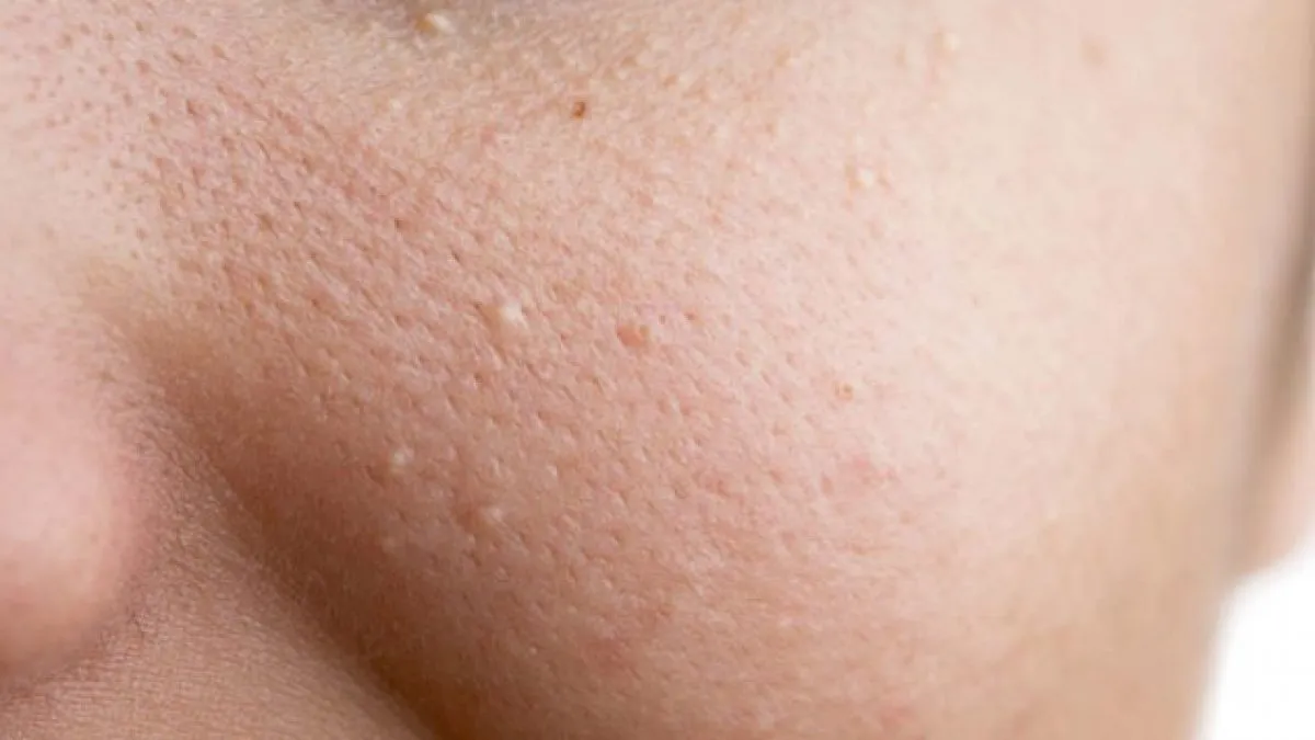 cach tri mun li ti tren mat