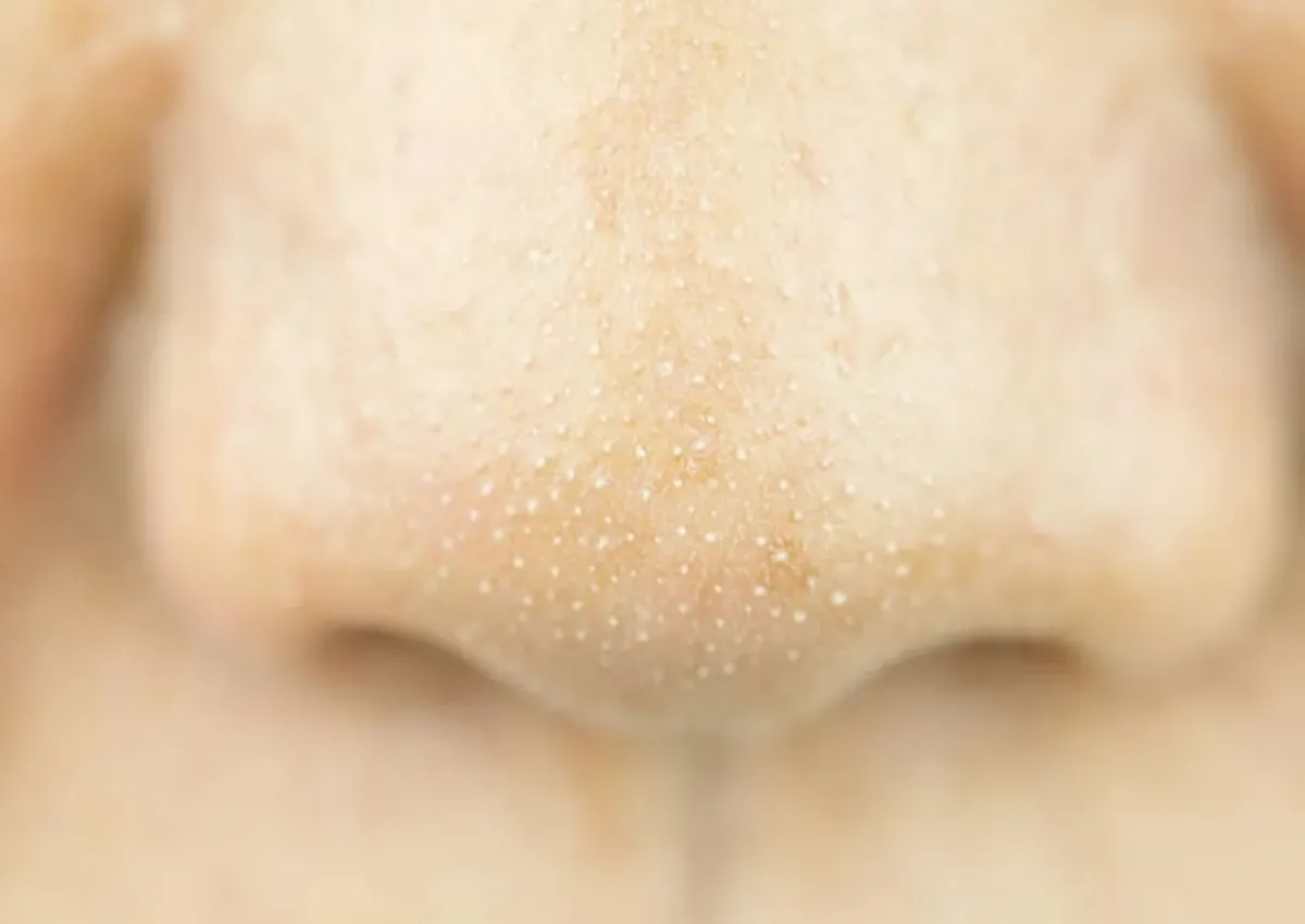 trị mụn li ti trên mặt