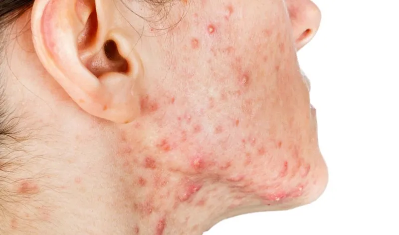 Mụn viêm là nguyên nhân gây ra thâm mụn ở mặt