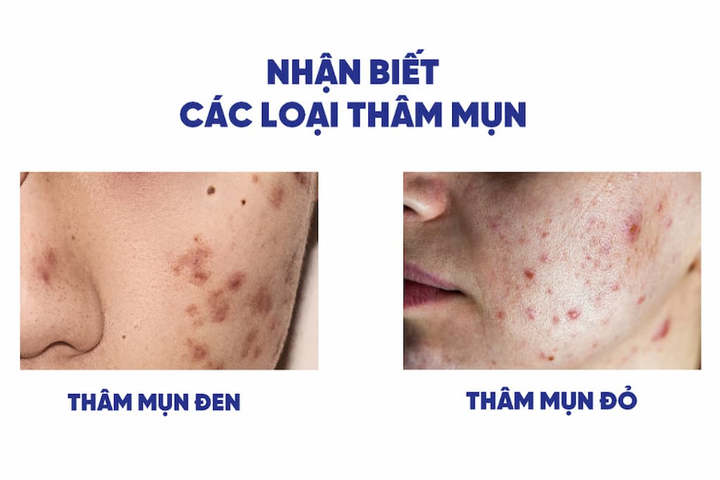 Thâm mụn là gì?
