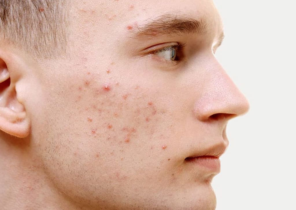 Thành phần khuyến cáo nên có trong kem bôi trị thâm mụn