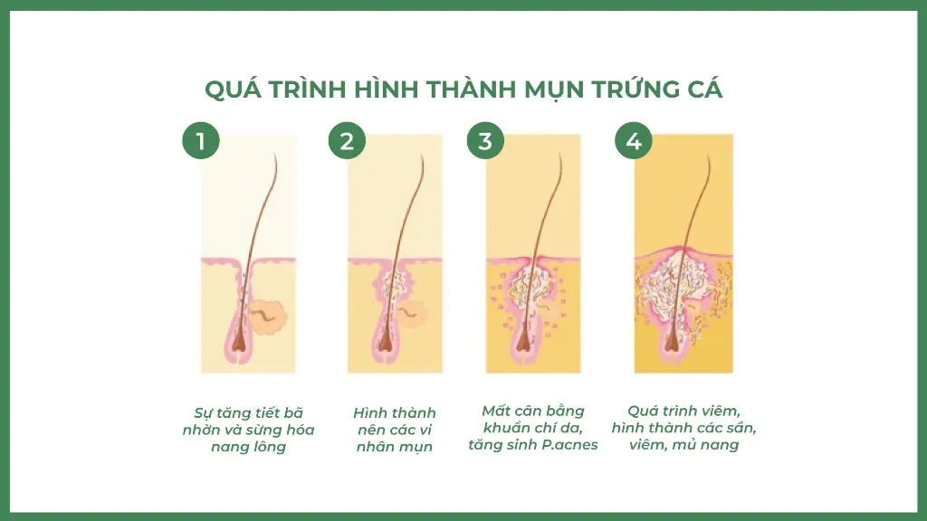 Mụn trứng cá dễ hình thành ở tuổi dậy thì