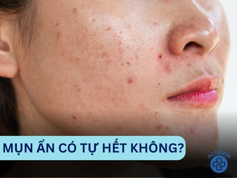 Mụn ẩn có tự hết không?