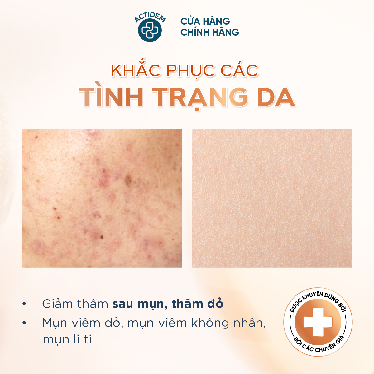 Bật mí sản phẩm loại bỏ mụn ẩn hiệu quả