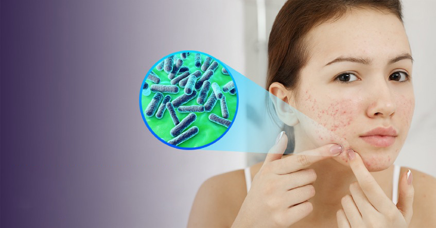 Môi trường ô nhiễm dễ biến làn da của bạn từ mụn ẩn thành mụn viêm