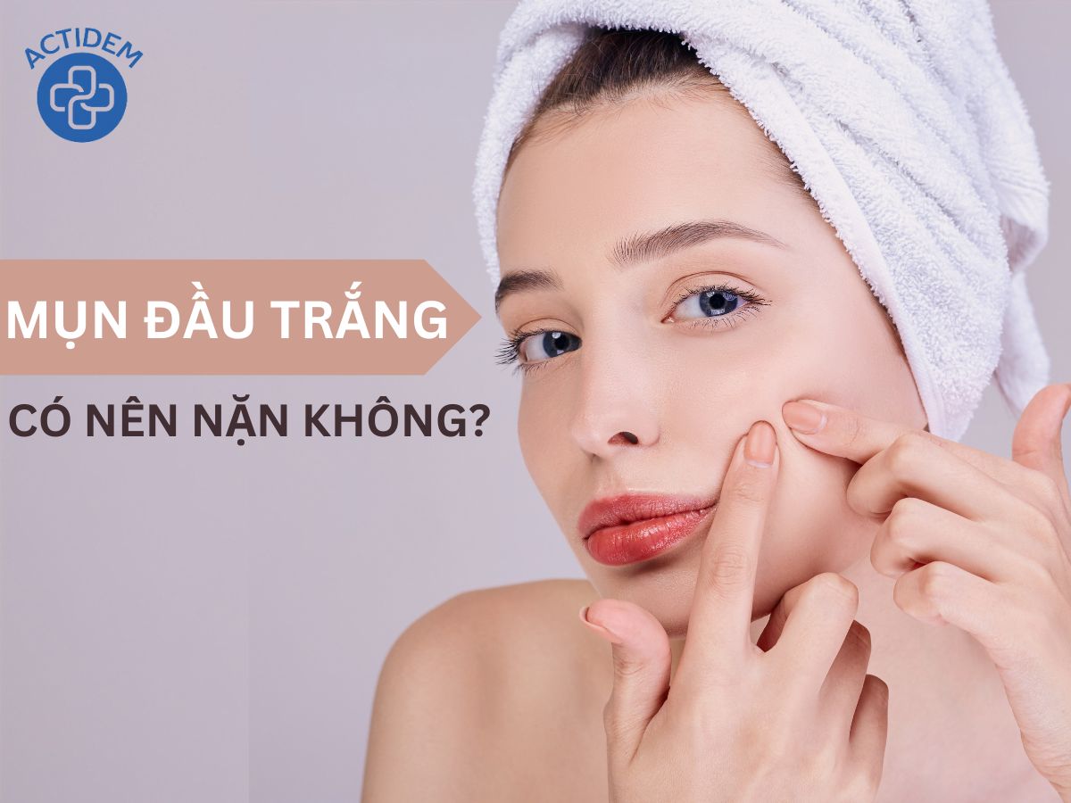 Mụn đầu trắng có nên nặn không?