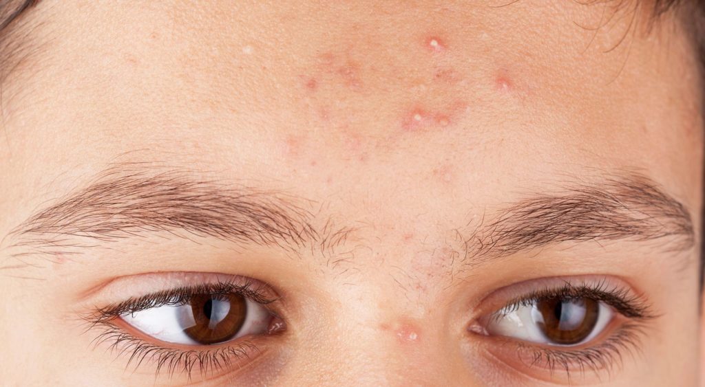 Mụn đầu trắng nhỏ liti có kích thước nhỏ, hình dạng tròn