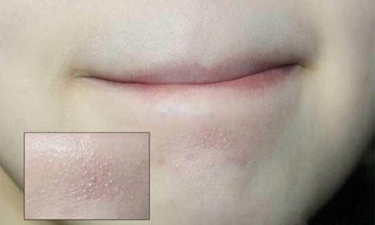 Mụn li ti dưới cằm