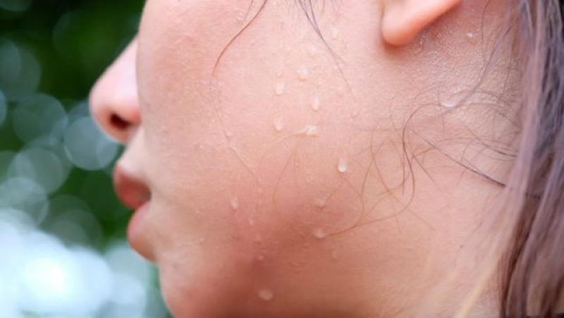 Mồ hôi có thể làm ẩm da, khiến lỗ chân lông bị tắc nghẽn và gây mụn