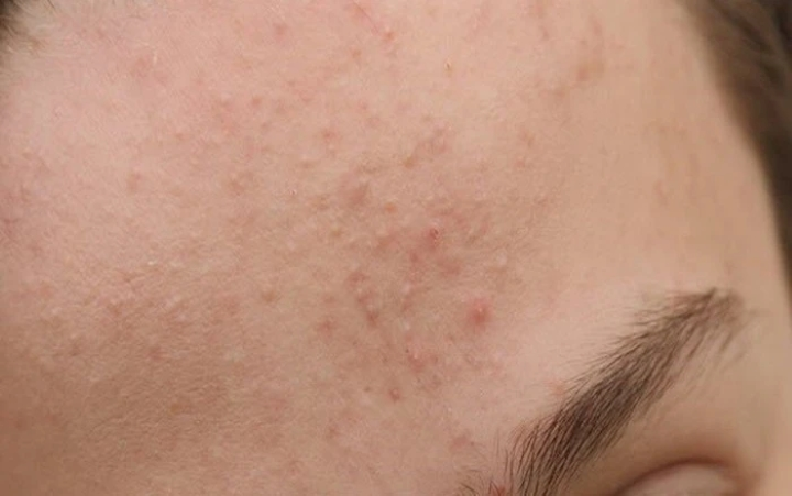 Mụn ti li ở trán