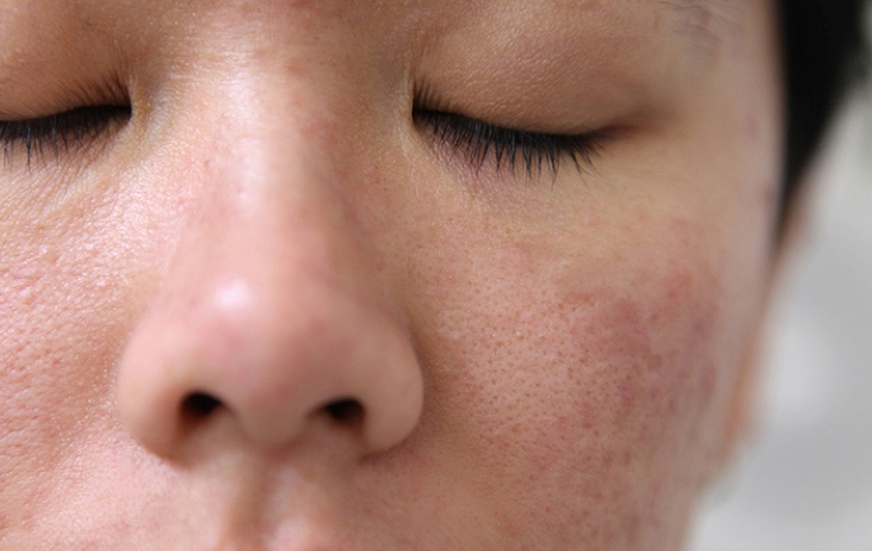 Da mặt bị viêm nang lông