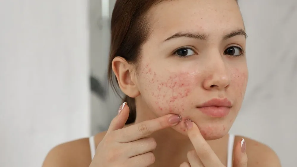 Cách nặn mụn đúng và an toàn