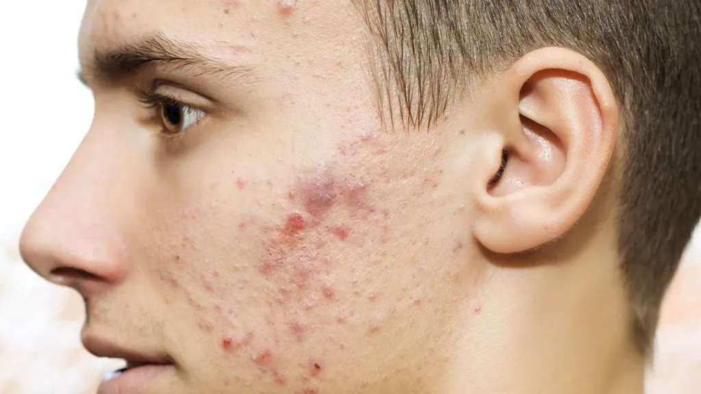 Các vùng dễ bị mụn nội tiết tố ở nam