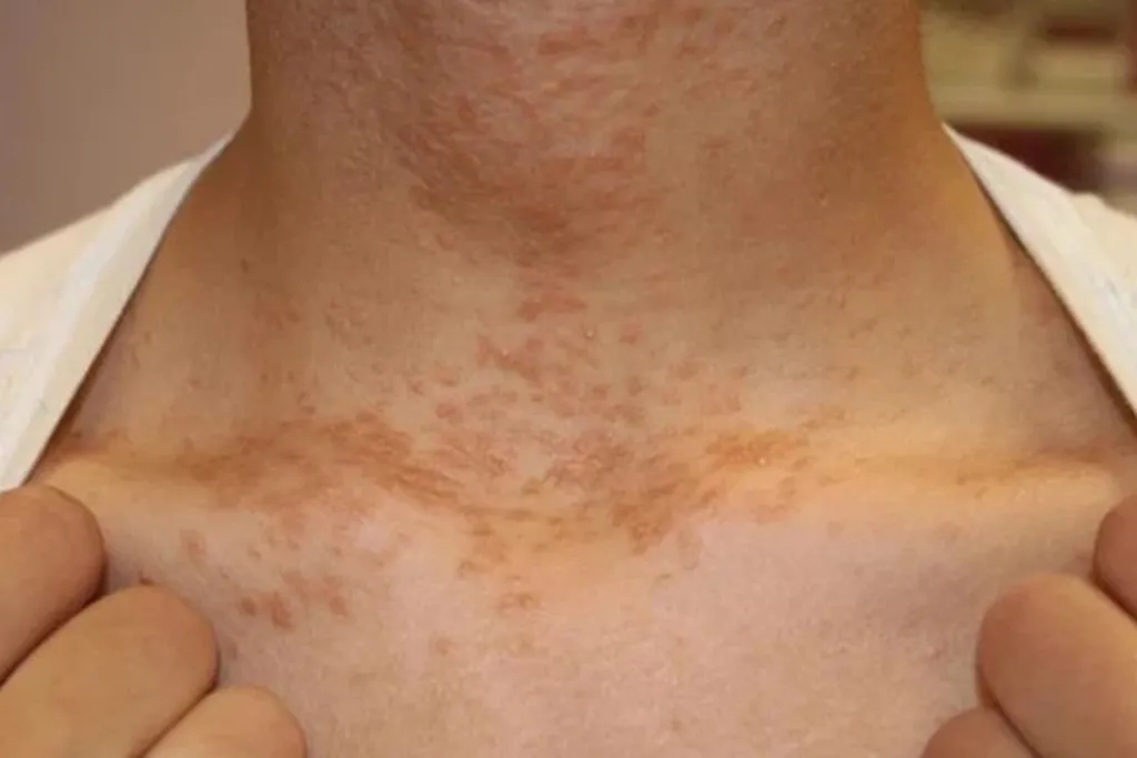 Mụn ở vùng cổ và cằm