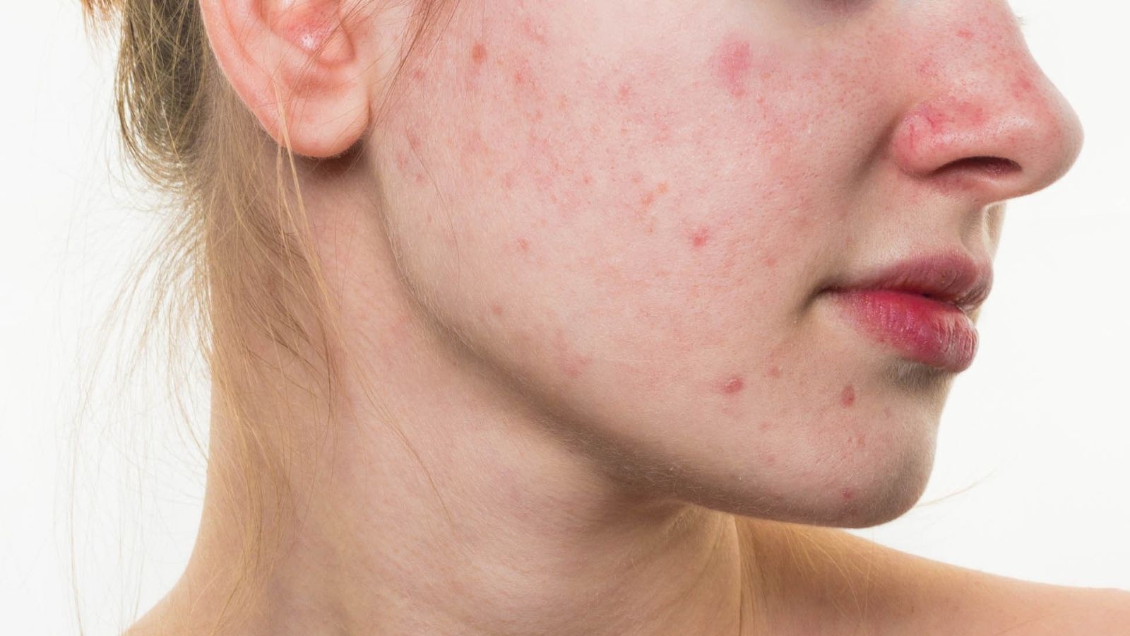 Mụn tái đi tái lại một chỗ do vi khuẩn Propionibacterium acnes
