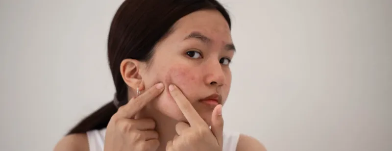 Mụn tái phát - vấn đề nhức nhối