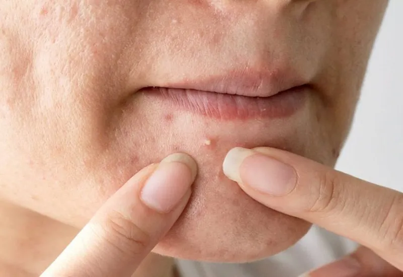 Chạm tay lên mặt là một nguyên nhân gây thâm mụn