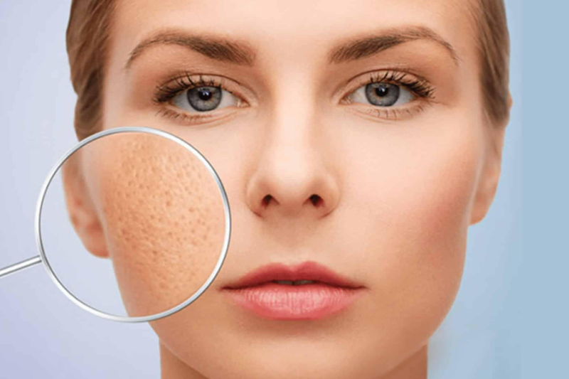 Nguyên nhân lỗ chân lông to ở vùng chữ T