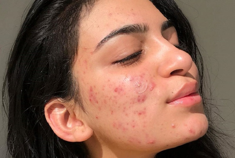 Tìm hiểu đẩy mụn là gì?