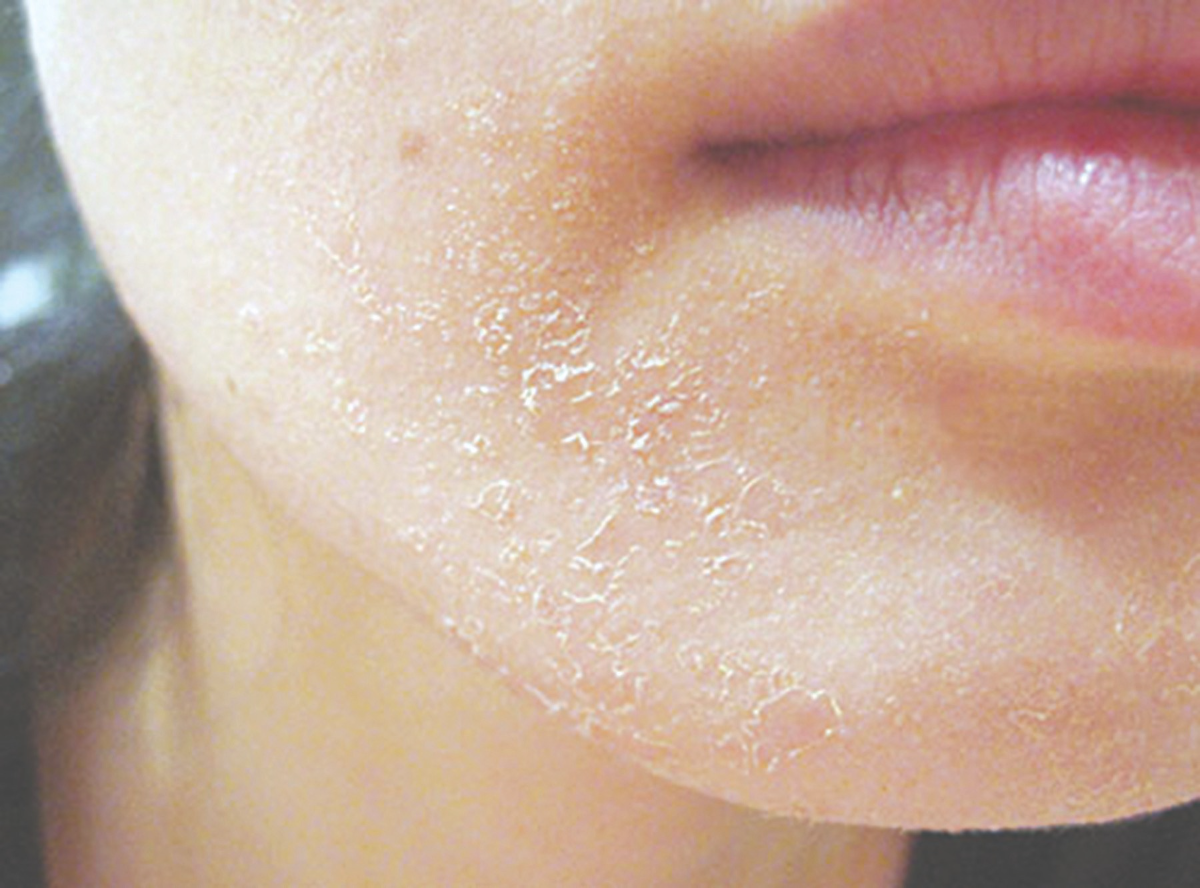 Da bị khô và bong tróc