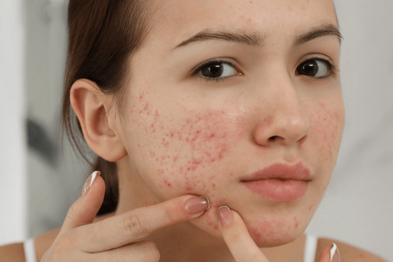 Định nghĩa cơ bản về mụn ẩn