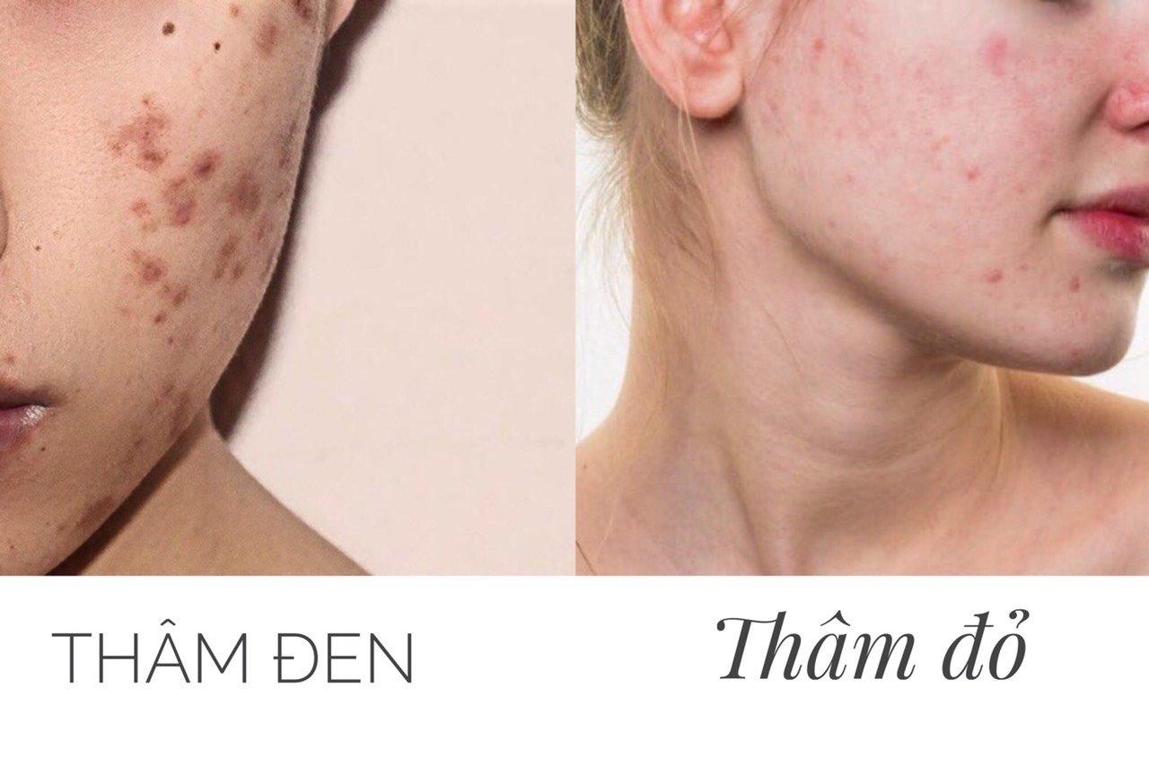 Phân biệt thâm đen và thâm đỏ