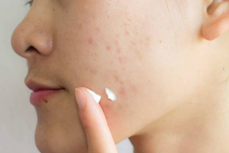 Mức độ nặng hay nhẹ của vết thâm mụn