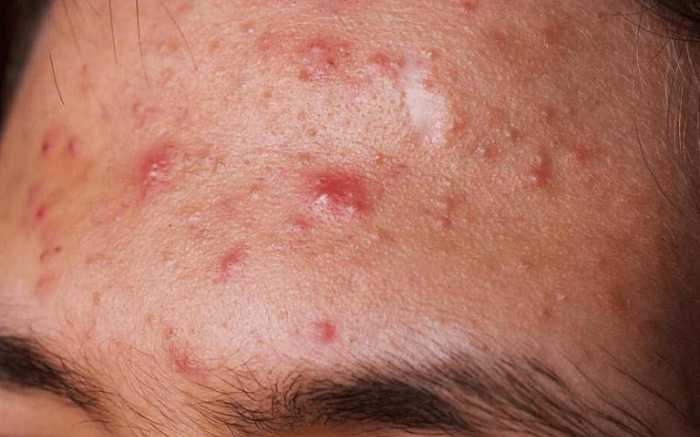 Vết thâm mụn bị viêm nhiễm