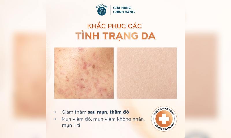 Actidem Derma Extra có tác dụng cực tốt đối với làn da bị mụn