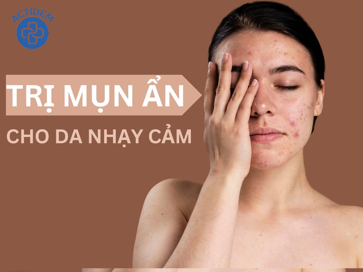 Trị mụn ẩn cho da nhạy cảm bằng cách nào?