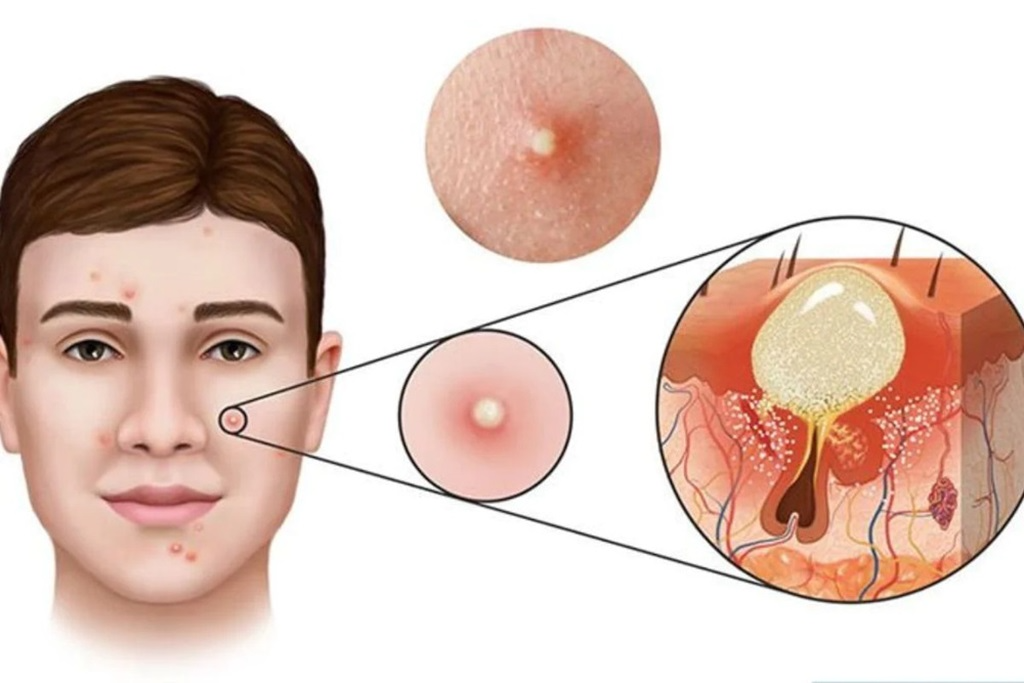 Mụn sưng đỏ viêm hình thành như thế nào?