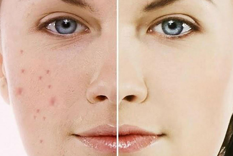 Cơ chế hoạt động của sản phẩm trị mụn thâm