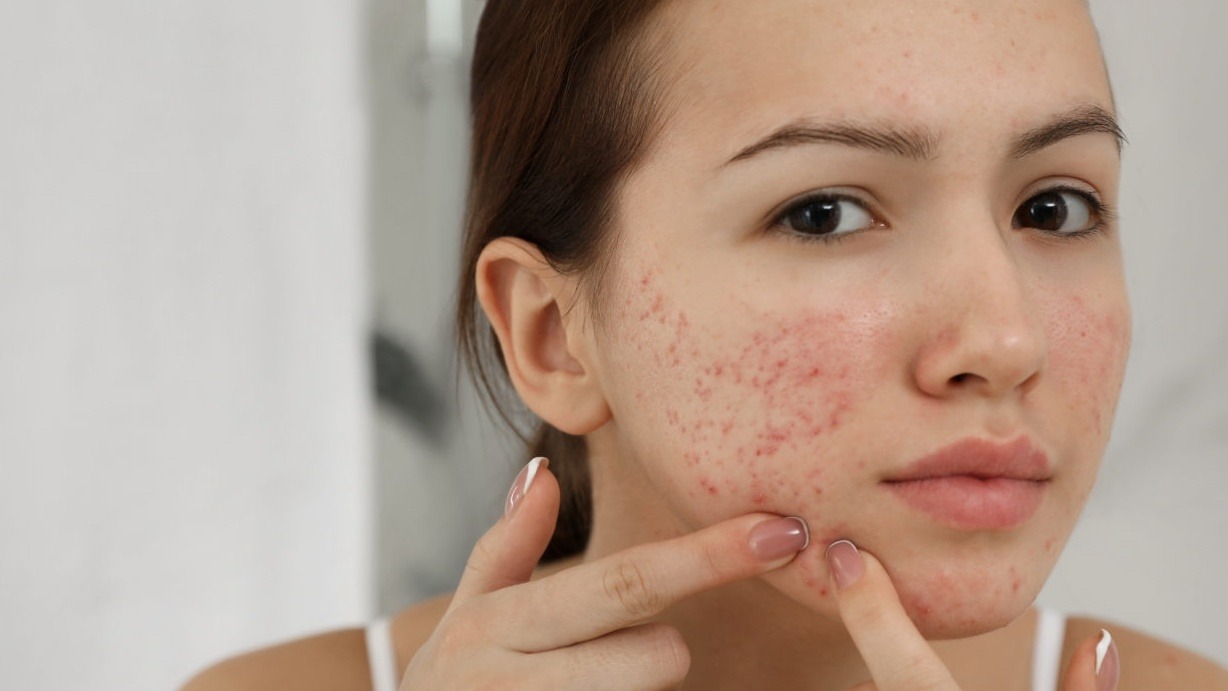 Nặn mụn có thể gây ra các vết thâm đỏ sau mụn