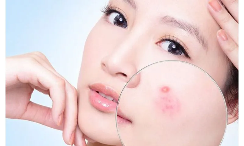 Tác dụng của viên uống trị thâm mụn