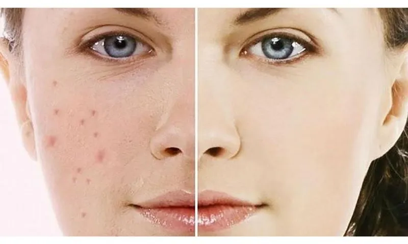 Viên uống trị thâm mụn giúp ngừa mụn, giảm thâm