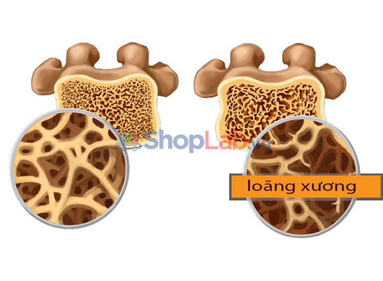 Canxi là thành phần giúp phòng ngừa loãng xương