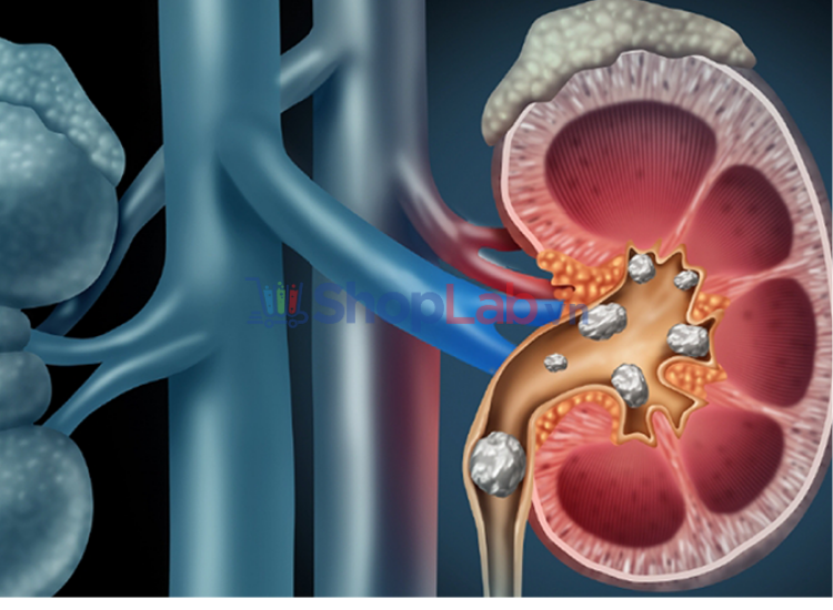 Thừa canxi gây sỏi thận