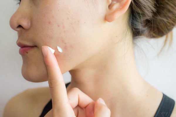 Phenoxyethanol khi kết hợp với một số hóa chất khác thì có công dụng tuyệt vời việc giúp da giảm mụn trứng cá