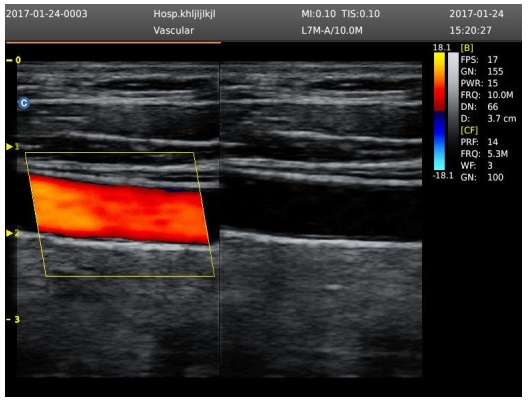 Máy Siêu Âm Xách Tay Eco3 Expert Chison: